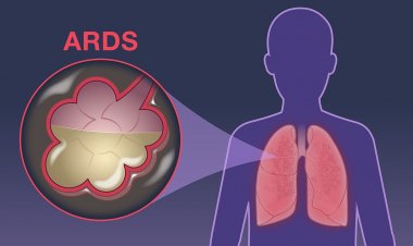 Coronavirus : Χαράλαμπος Μόσχος - Στις σοβαρότερες μορφές οι πνεύμονες αντί για αέρα γεμίζουν με «υγρό»
